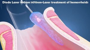 Laser Hemorrhoidoplasty (LHP) - IBI Healthcare Institute