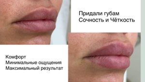 Контурная пластика губ: акцент на контурах с филлером Белотеро