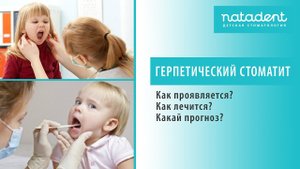 30. Острый герпетический стоматит у детей. Как лечить? Натадент Стоматология