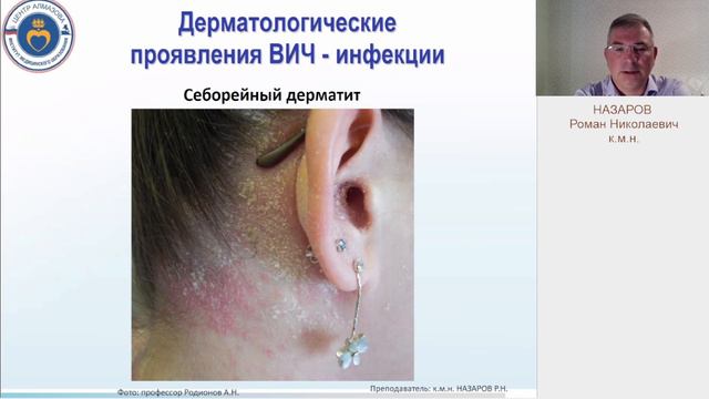 Назаров Р.Н. Дерматологические проявления ВИЧ - инфекций смотреть онлайн