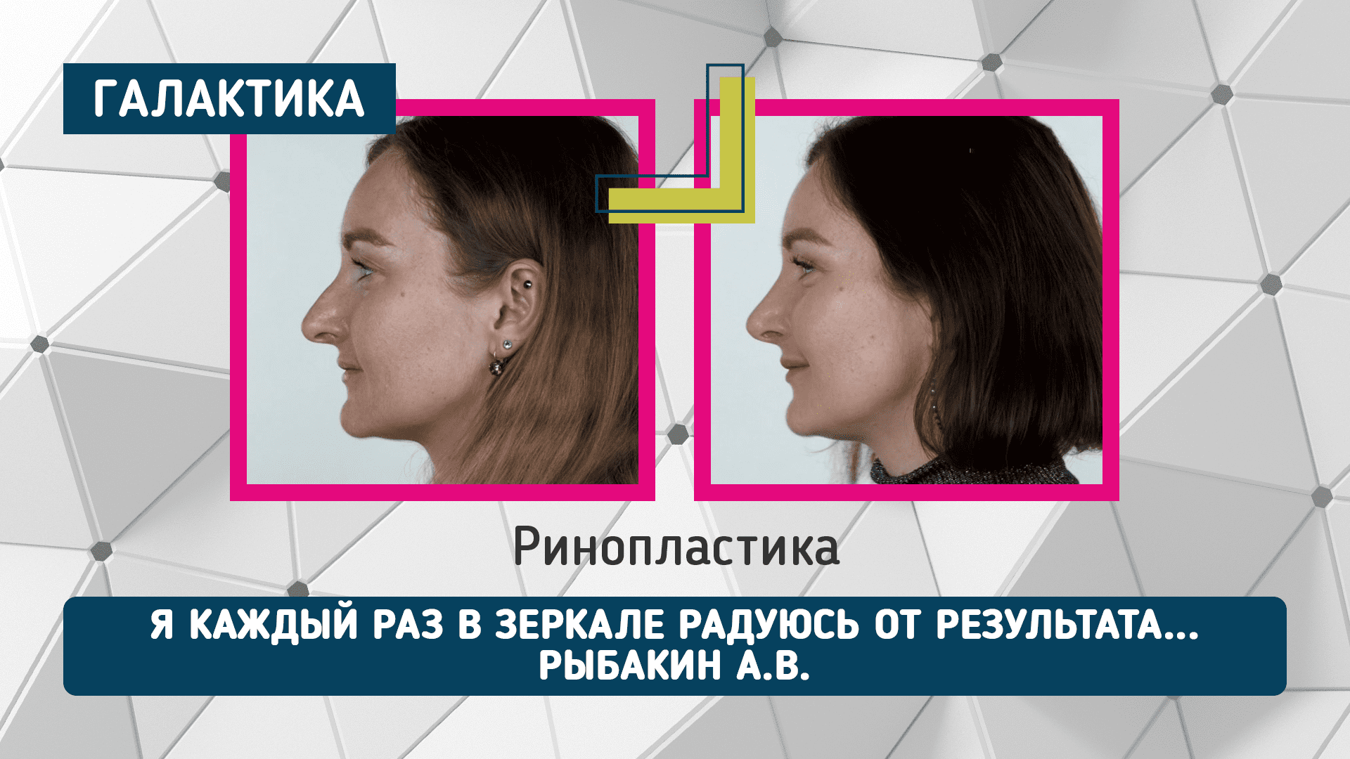 Ринопластика после перелома | Рыбакин Артур Владимирович