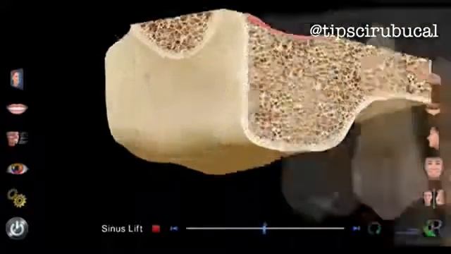 Синус-лифтинг смотреть онлайн