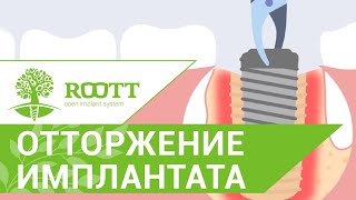 Причины и признаки отторжения импланта. Отторжение импланта. ROOTT