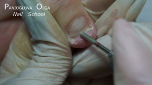 Онихолизис  на большом пальце часть 2 ДИНАМИКА РОСТА НОГТЯ