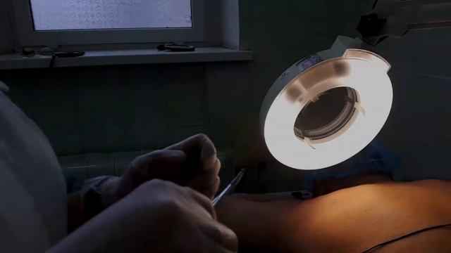 Удаление невуса на пояснице смотреть онлайн