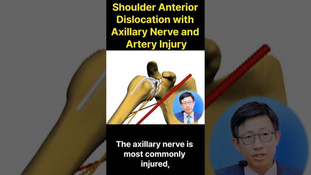 Shoulder Dislocation Axillary with Nerve and Artery injury