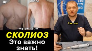 Сколиоз❗️Поразительные Изменения 😳 Это Важно Знать #сколиоз