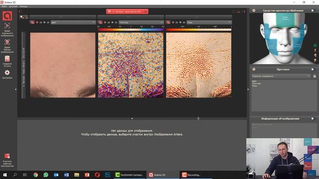 Antera 3D: трехмерная визуализация поверхности кожи. Диагностика и оценка эффективности процедур смотреть онлайн