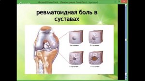 Боль в суставах. Елена Бахтина, врач-гинеколог, генетик, нутрициолог.