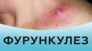 Фурункулез _ Фурункулы как лечить _ Причины фурункулеза.