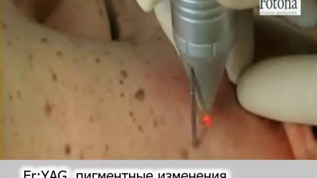 Лазерное удаление пигментации в Кременчуге.Салон Лилу смотреть онлайн