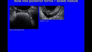 This is one of several 'As Live' scans to demonstrate how to image endometriosis by Susanne Johnson