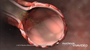 Эмпиема плевры|Внутренние болезни