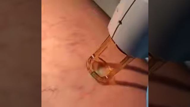 сосуды на ногах смотреть онлайн