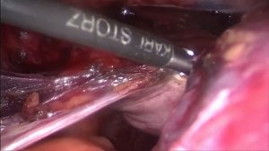 Лапароскопия, ампутация матки