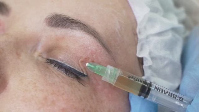 Мастер-класс «Комбинированная терапия COLLOST Micro и PRP в одном шприце»