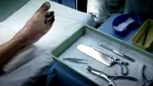 № 25 Ролик ампутация при гангрене "Бросить курить"