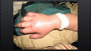 Действия при укусе гадюки