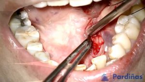 Salivary duct STONE – Sialolithiasis - How to treat?