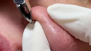 NOSE ACNE - Ance treatmant Mai Ngoc