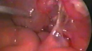 Лапароскопическая аппендэктомия у ребёнка