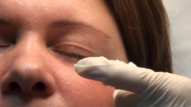 Техника коррекции иглой вокруг глаз смотреть онлайн