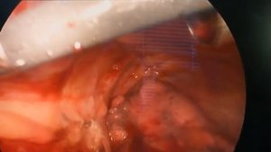 Торакоскопическое удаление образования переднего средостения