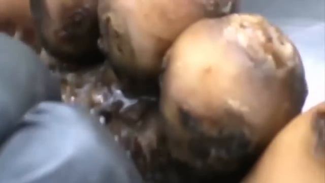 How to remove a jigger from the foot - วิธีการลบ Jigger จาก เท้า P1 смотреть онлайн