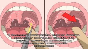 Обострение тонзиллита