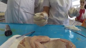 Пластика встречными треугольниками по Лимбергу