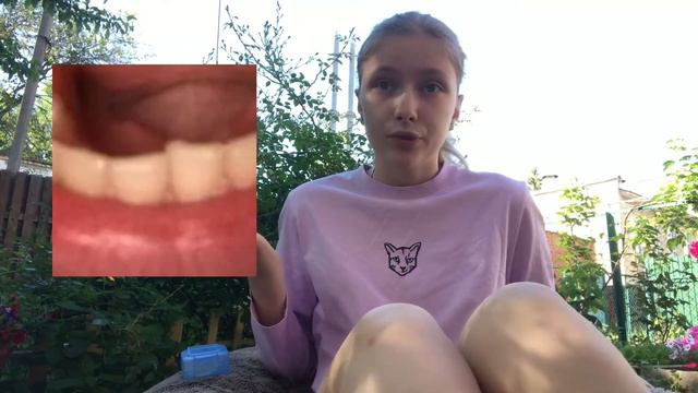 Что произошло после месяца носки капы? Есть ли изменения?LM-Aktivator🦷 смотреть онлайн