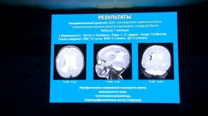 Кукота У.А. - МРТ в диагностике младенческих эпилептических энцефалопатий