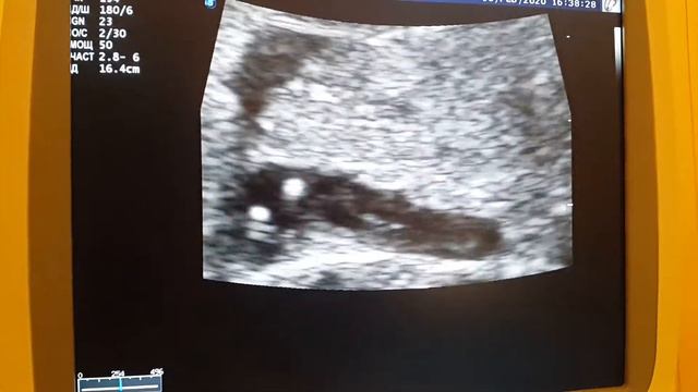 Странный желчного пузырь у плода(2) смотреть онлайн