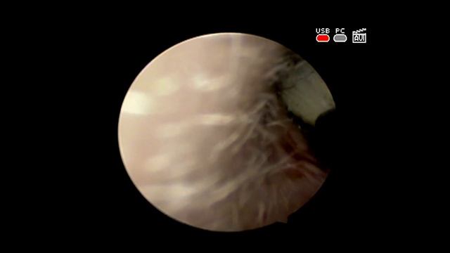 Удаление инородного тела #чеснока из #уха после народного #лечения смотреть онлайн