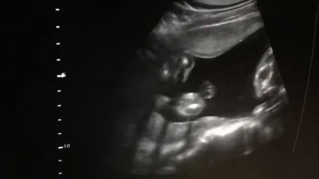 В ИНВИТРО-Воскресенск появился новый аппарат УЗИ. Аппарат новый, а цены прежние! смотреть онлайн