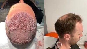 Пересадка волос 5100 графтов / hair transplant 5100 grafts