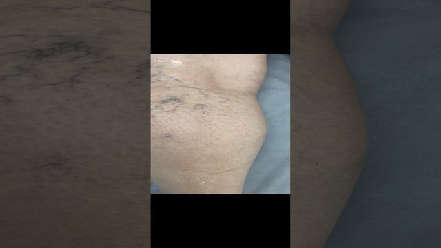 Сосудистая сетка на ногах. Флеболог Москва. Флеболог смотреть онлайн