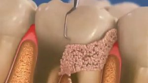 Процесс удаления зубного камня