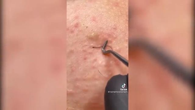 Popping huge blackheads and Pimple Popping - Best Pimple Popping Videos #31