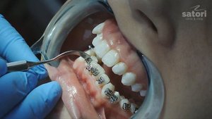 Брекеты– фиксация, установка дуг, разметка моделей | стоматология и ортодонтия самара влог