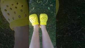 После перелома нижней трети большой берцовой кости. 10 месяцев спустя