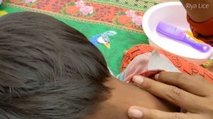 Getting out hundred lice from head - Remove thousand lice from hair