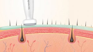 Мезоштамп Wheneva bio needle