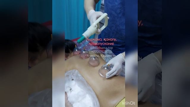 Как делается хиджама? Процедура кровопускания.