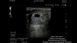 Узел в щитовидной железе Arietta V60