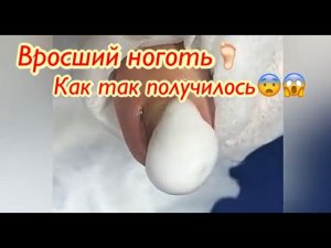 Вросший ноготь?Как так получилось?