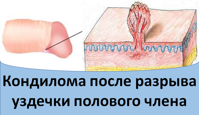 Кондилома после разрыва уздечки полового члена