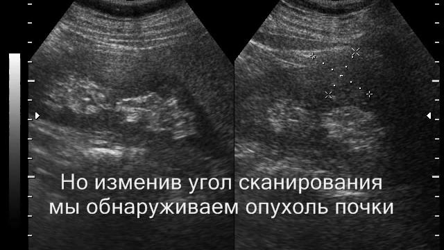 Обратная сторона ультразвуковых сонограмм.wmv смотреть онлайн