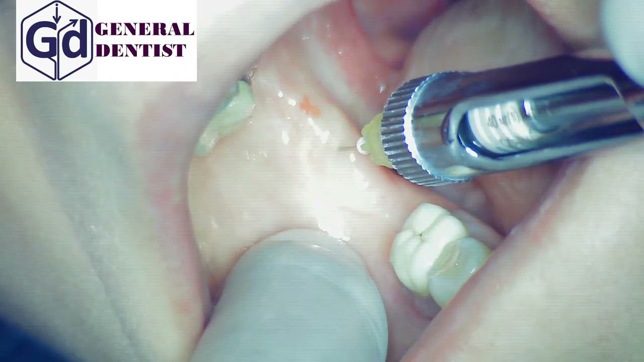 Inferior alveolar nerve block for implantation empty 47.