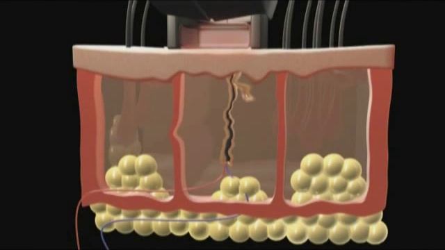 elos эпиляция смотреть онлайн